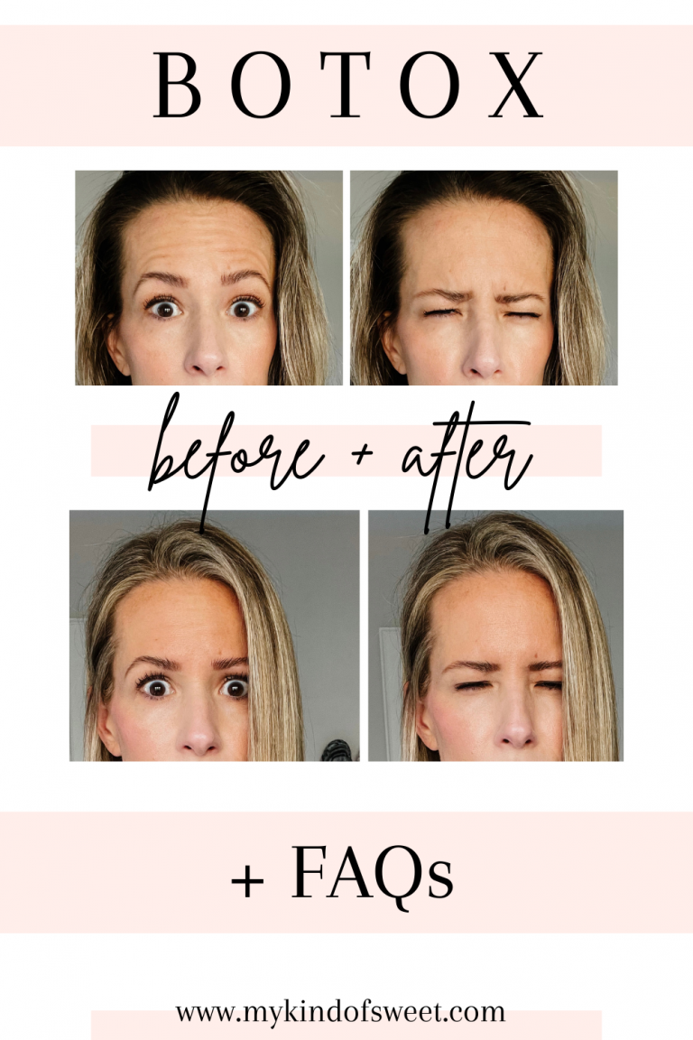 Botox Before After Your Questions Answered My Kind Of Sweet   Botox 768x1152 