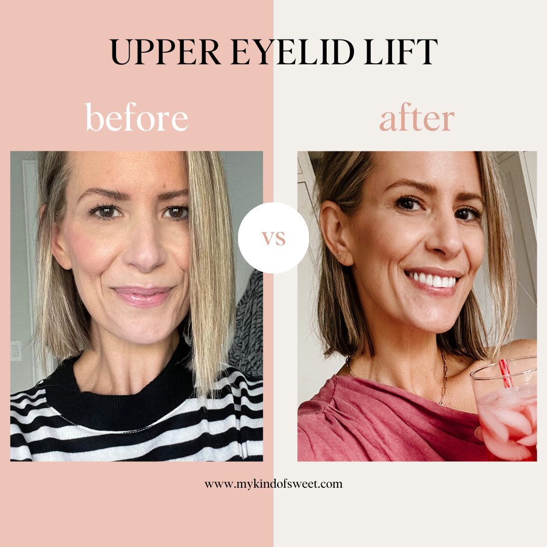 Upper Eyelid Lift | Before + After